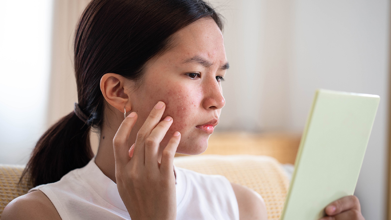 advising-on-acne-summary-image